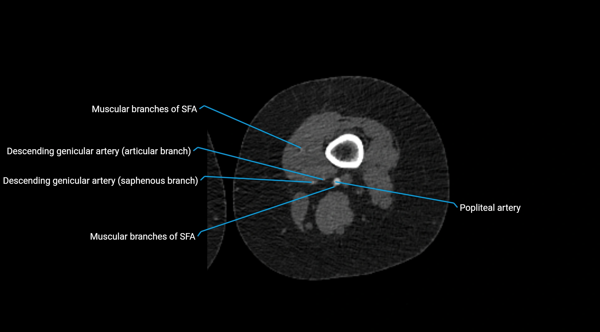 CTA lower limb cross sectional anatomy labelled image _153.webp